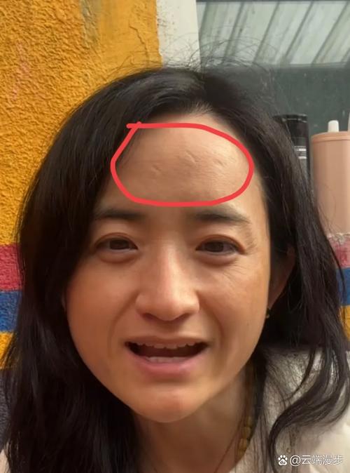 额头有疤的成功人士_哪些女明星额头有疤_额头有疤的女明星